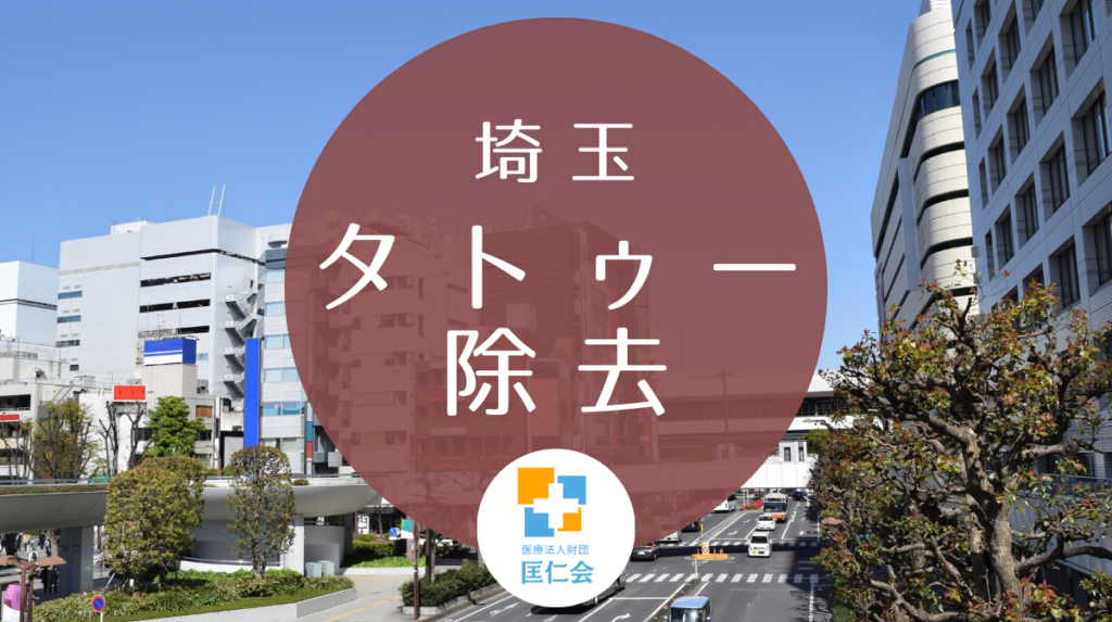 埼玉 タトゥー除去