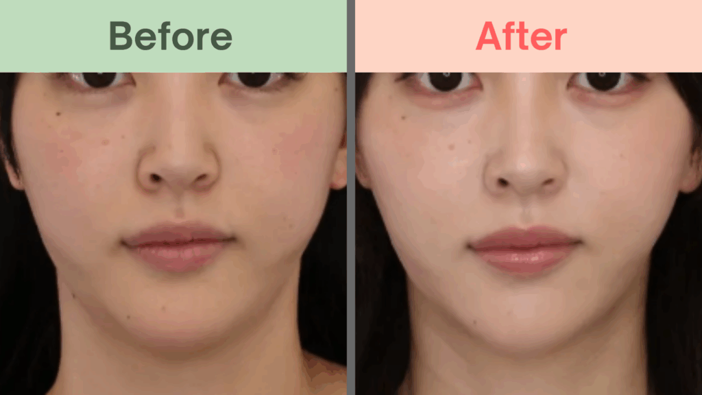 TAクリニックエラボトックス症例